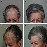 Hair Fall