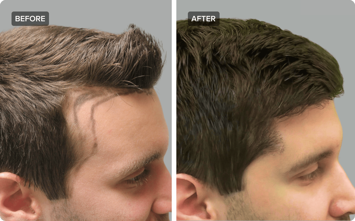 HairTransplant_01 Hair Transplants