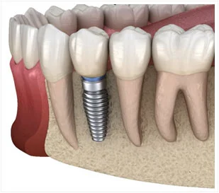 Dental Implants Treatment in Aberdeen