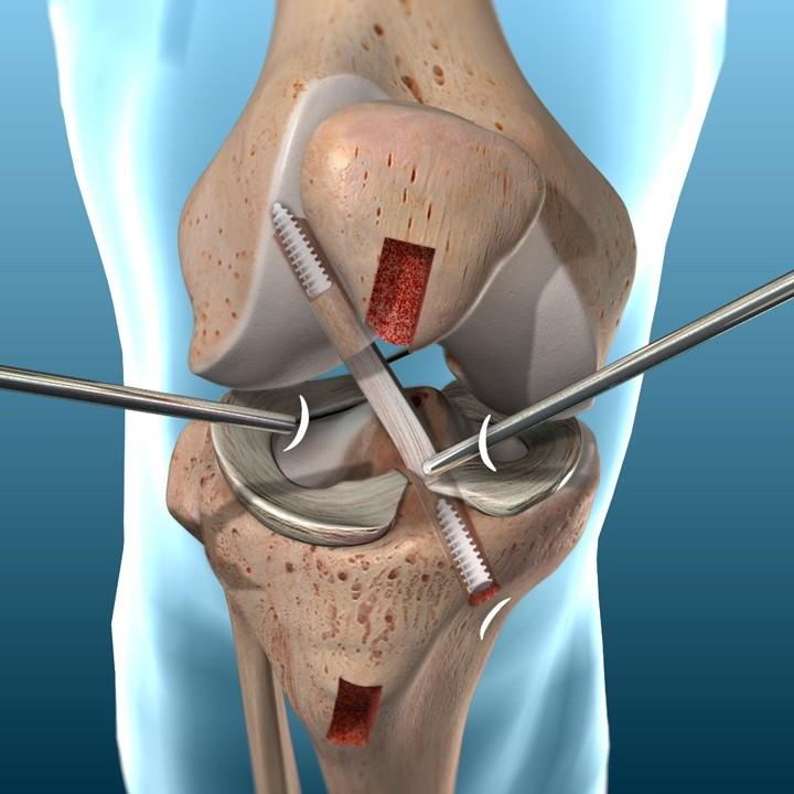 Best ACL Surgeon in India