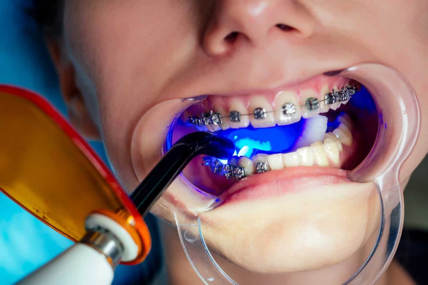 orthodontist miami
