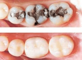White Cavity Filling Haddad dental
