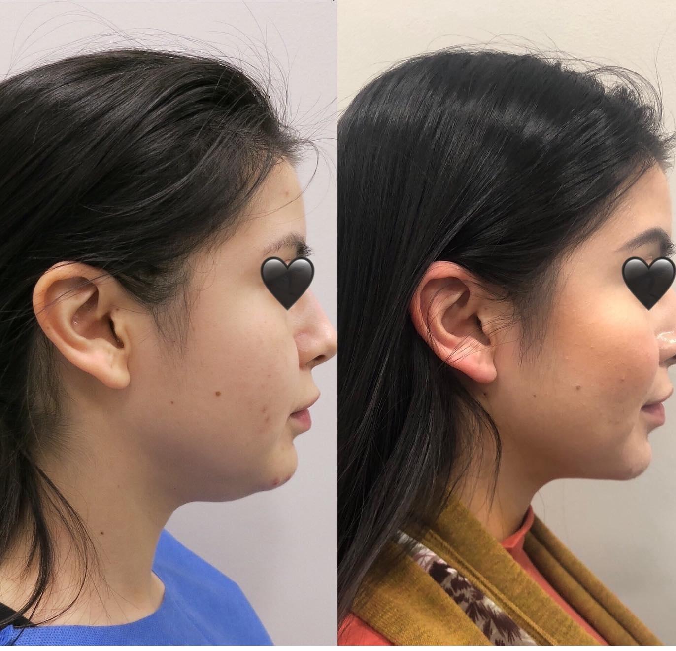 eyelid surgery cost (2) eye lift surgery cost