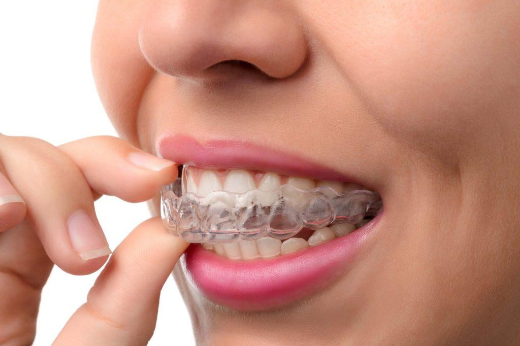 recommended braces singapore