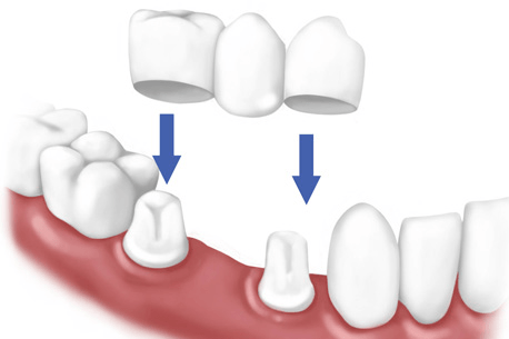 Dental crowns in canberra
