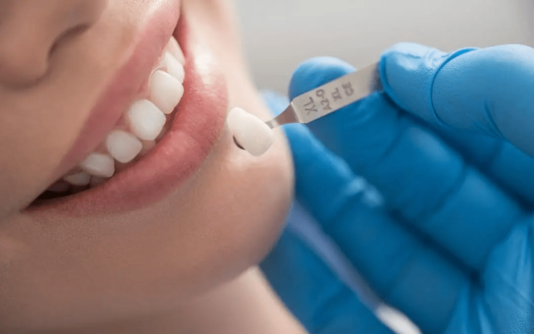 Dental crowns canberra