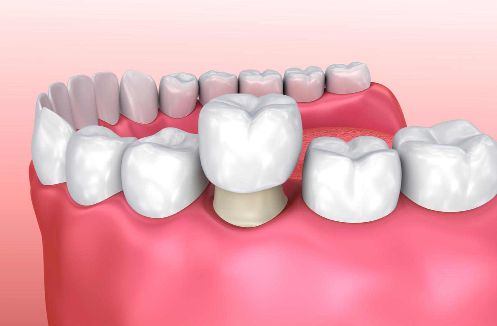 dental crowns canberra