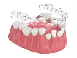 invisible braces cost in Ahmedabad