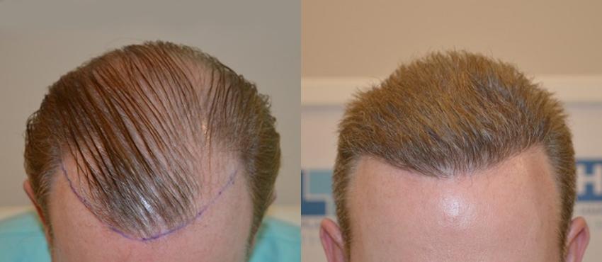 Hair transplant in Delhi