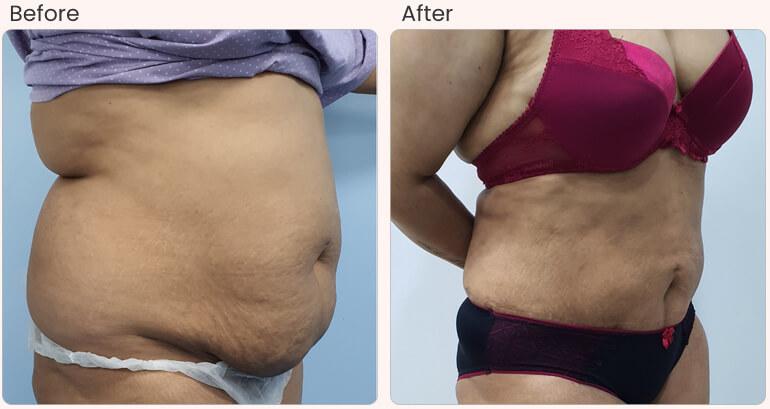 Liposuction In Dubai