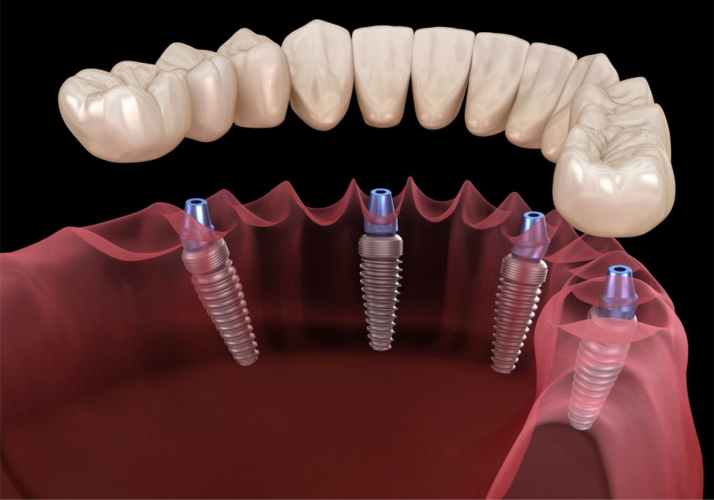 all in four dental implants