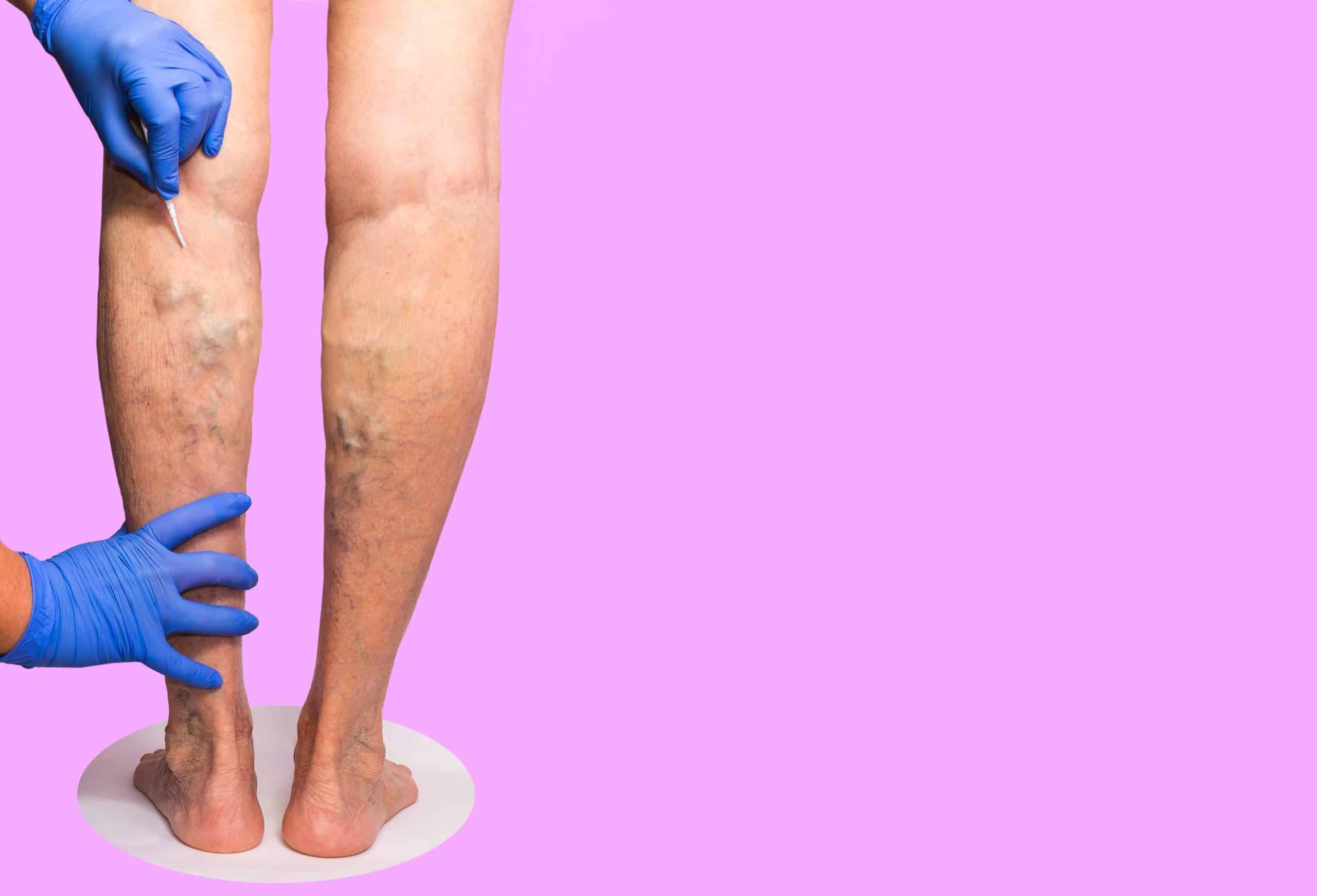 what kind of doctor treats varicose veins what kind of doctor treats varicose veins