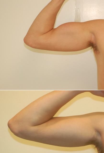 Best Bicep Implants in San Francisco