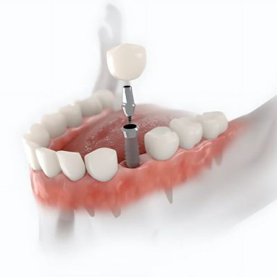 dental implants nyc